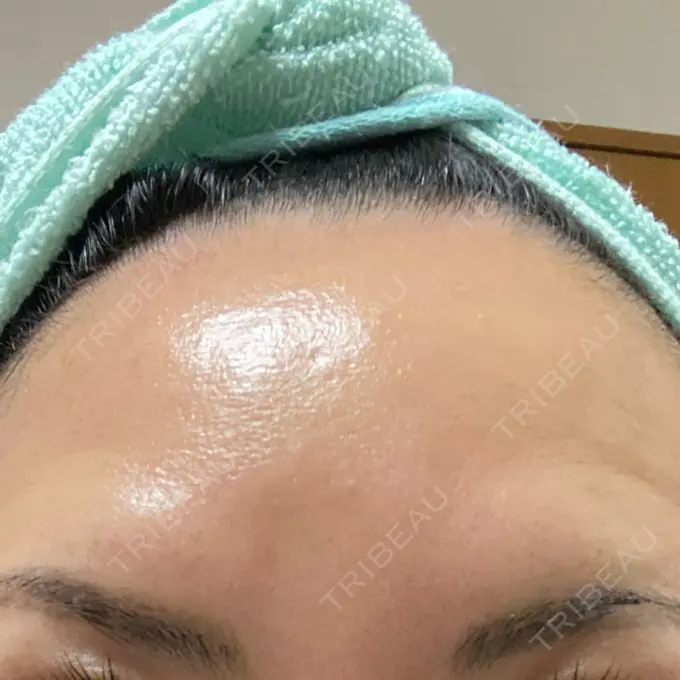 ボトックス（額） TCB東京中央美容外科 神戸院 DAY 14 メイン用