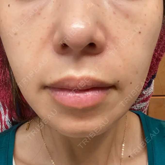 水光注射（ハリ・美肌） 筋肉・美容クリニック DAY 3 メイン用