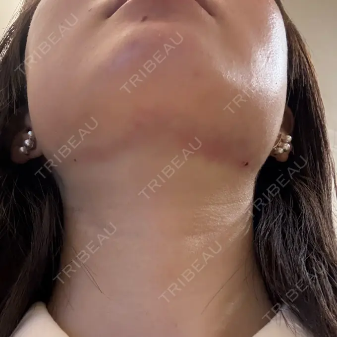 脂肪吸引注射（顔） / ボトックス（エラ・小顔） / RF（高周波）たるみ治療 Wing clinic 豊中駅前院 DAY 0 メイン用