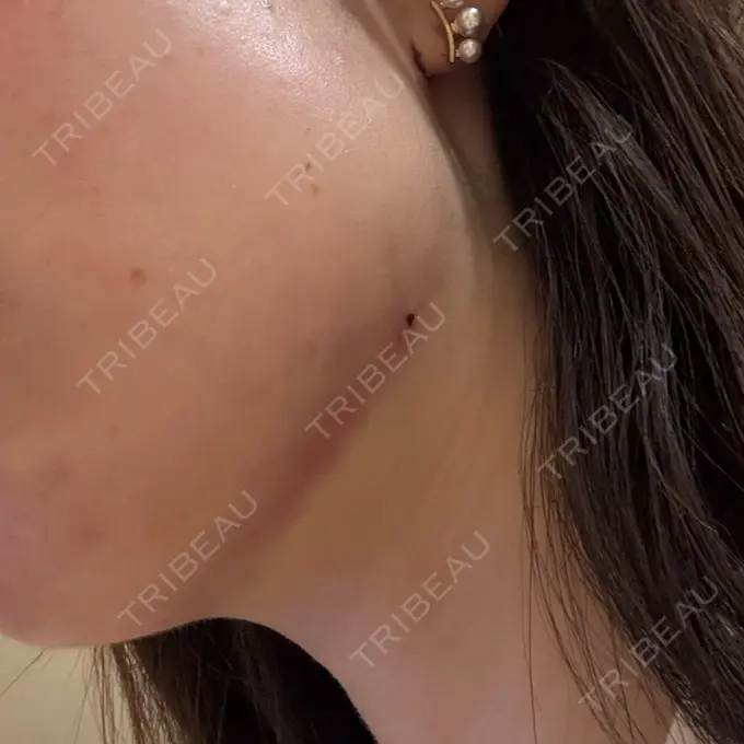 脂肪吸引注射（顔） / ボトックス（エラ・小顔） / RF（高周波）たるみ治療 Wing clinic 豊中駅前院 DAY 0 メイン用