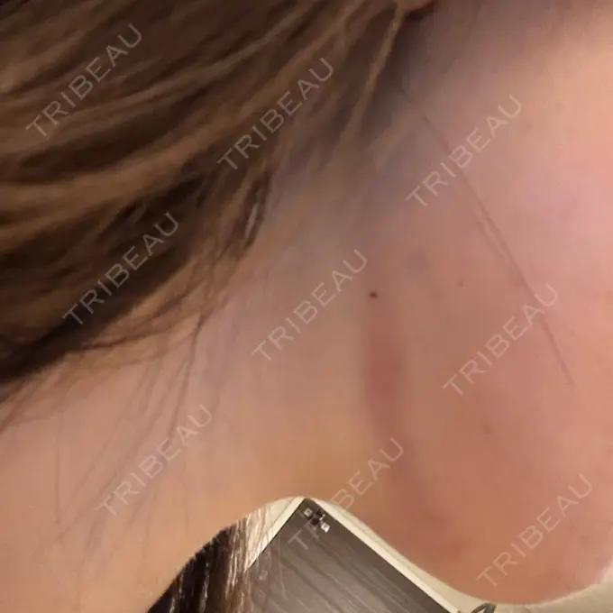 脂肪吸引注射（顔） / ボトックス（エラ・小顔） / RF（高周波）たるみ治療 Wing clinic 豊中駅前院 DAY 0 メイン用