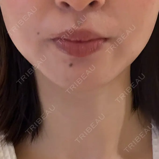 脂肪吸引注射（顔） / ボトックス（エラ・小顔） / RF（高周波）たるみ治療 Wing clinic 豊中駅前院 AFTER メイン用