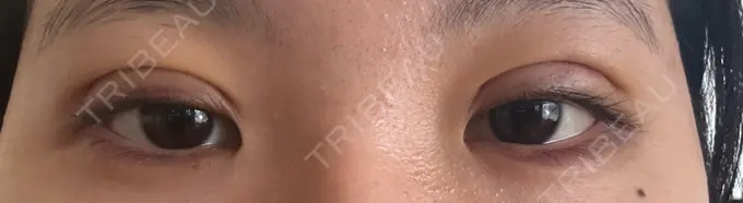 二重埋没 / 自然癒着法 東京シンデレラ美容外科 池袋院 DAY 3 メイン用