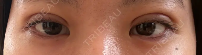 二重埋没 / 自然癒着法 東京シンデレラ美容外科 池袋院 DAY 6 メイン用