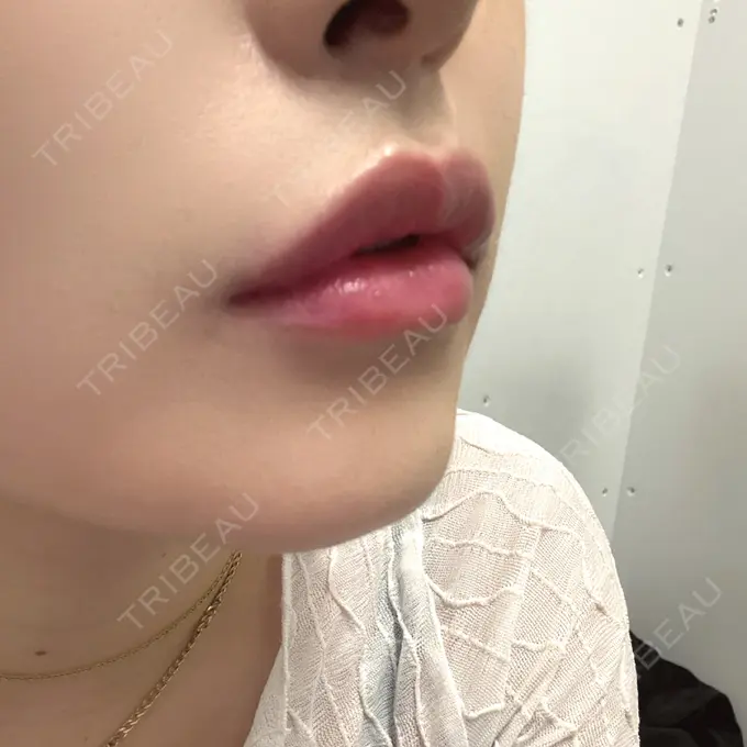 ボトックス（あご） / ヒアルロン酸注入（唇） / ボトックス（口角） eクリニック 那覇院 AFTER メイン用