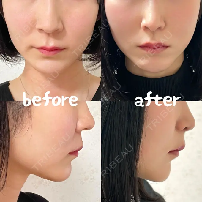 小鼻縮小（切開） / 人中短縮 / 鼻翼挙上 / 鼻翼基部形成（貴族手術） / 鼻柱下降・鼻唇角形成（猫手術） Otus Clinic 【オータスクリニック】 DAY 95 メイン用