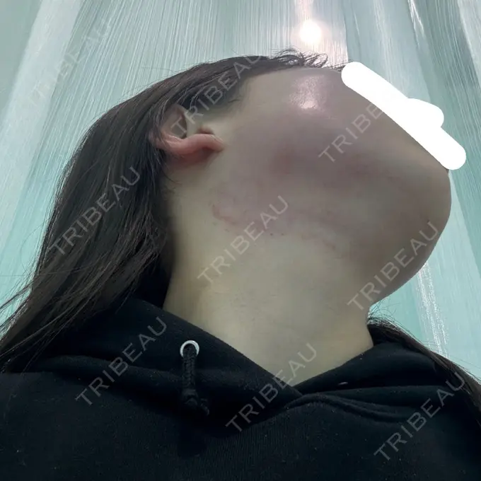 ボトックス（エラ・小顔） / RF（高周波）たるみ治療 Wing clinic 豊中駅前院 DAY 0 メイン用