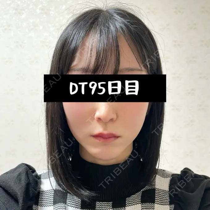 小鼻縮小（切開） / 人中短縮 / 鼻翼挙上 / 鼻翼基部形成（貴族手術） / 鼻柱下降・鼻唇角形成（猫手術） Otus Clinic 【オータスクリニック】 DAY 95 メイン用