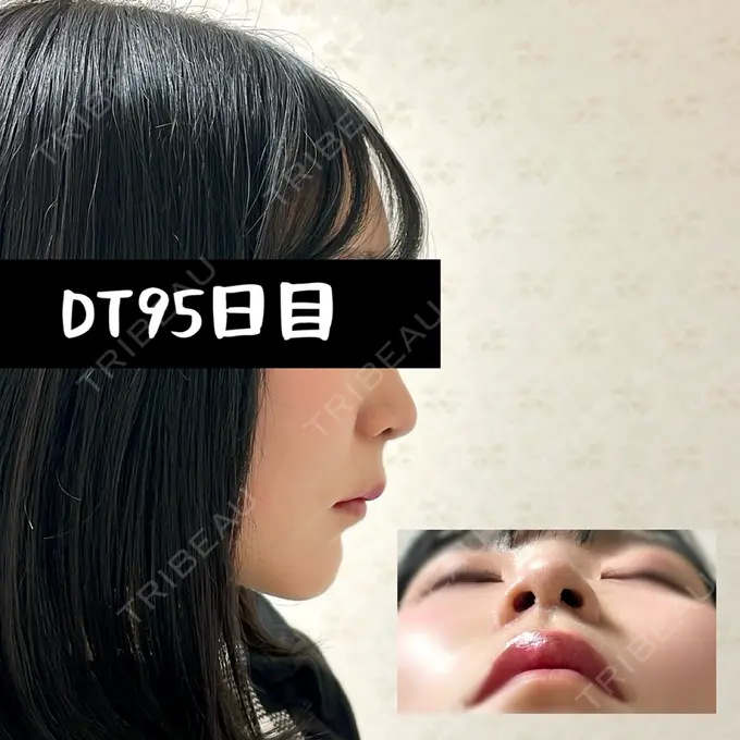 小鼻縮小（切開） / 人中短縮 / 鼻翼挙上 / 鼻翼基部形成（貴族手術） / 鼻柱下降・鼻唇角形成（猫手術） Otus Clinic 【オータスクリニック】 DAY 95 メイン用