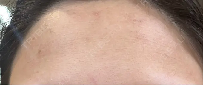 ルメッカ Chloe Cheongdam Clinic （クロエチョンダムクリニック） DAY 1 メイン用