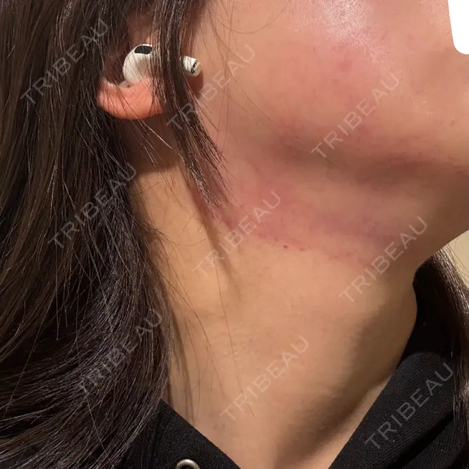 ボトックス（エラ・小顔） / RF（高周波）たるみ治療 Wing clinic 豊中駅前院 DAY 1 メイン用