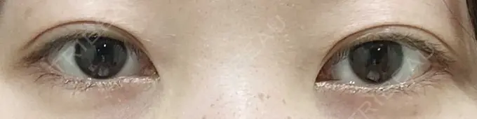 二重埋没 聖心美容クリニック 六本木院 DAY 6 メイン用