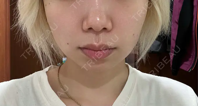 ピコスポット 東京シルククリニック 新宿院 AFTER メイン用