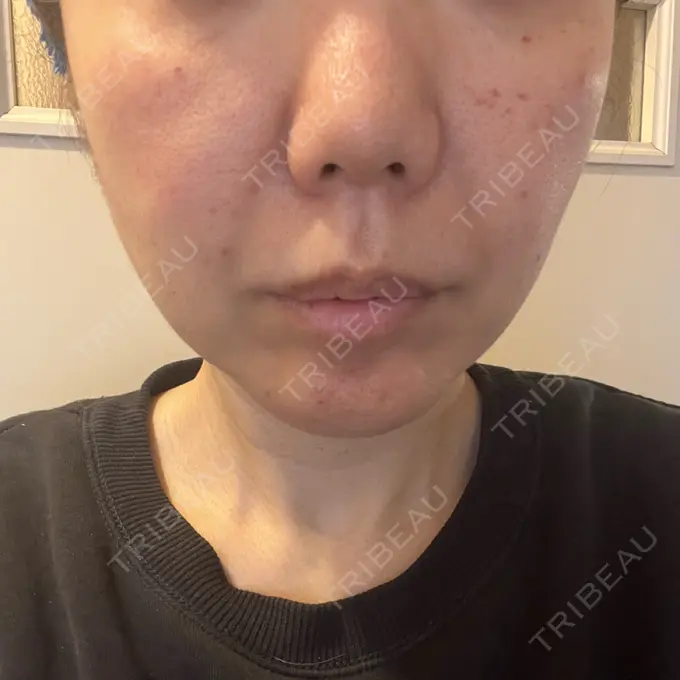 水光注射（ハリ・美肌） 筋肉・美容クリニック AFTER メイン用