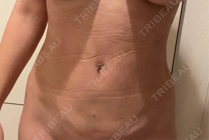 脂肪吸引（お腹） / 脂肪吸引（腰） オアシス美容外科 DAY 13 メイン用