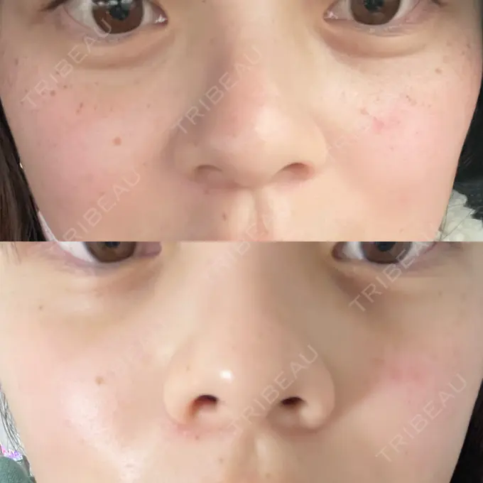 ルメッカ ルラ美容クリニック 千葉院 / ルラスキンクリニック 千葉院 AFTER メイン用