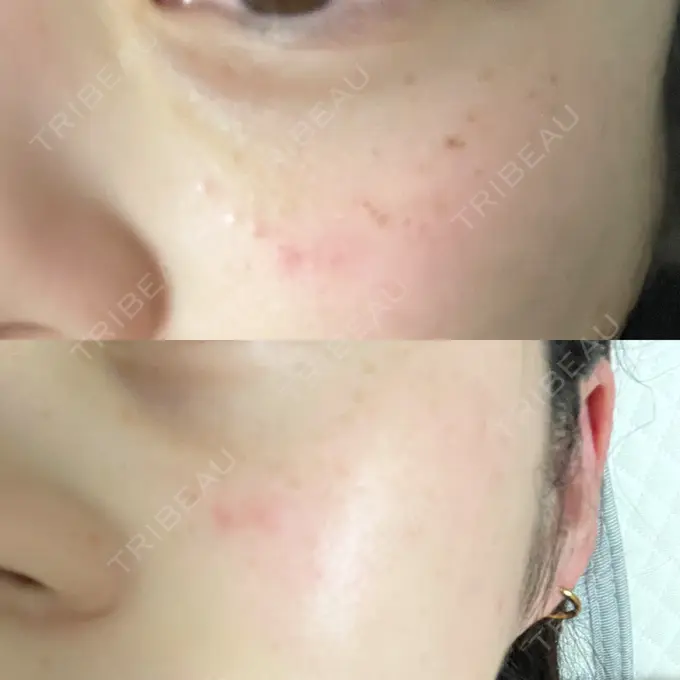 ルメッカ ルラ美容クリニック 千葉院 / ルラスキンクリニック 千葉院 DAY 0 メイン用