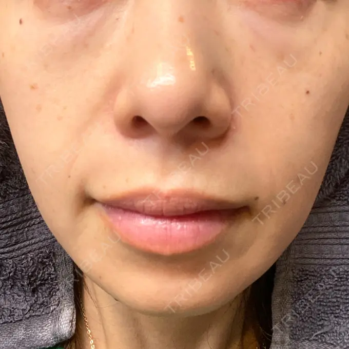 水光注射（ハリ・美肌） 筋肉・美容クリニック DAY 6 メイン用