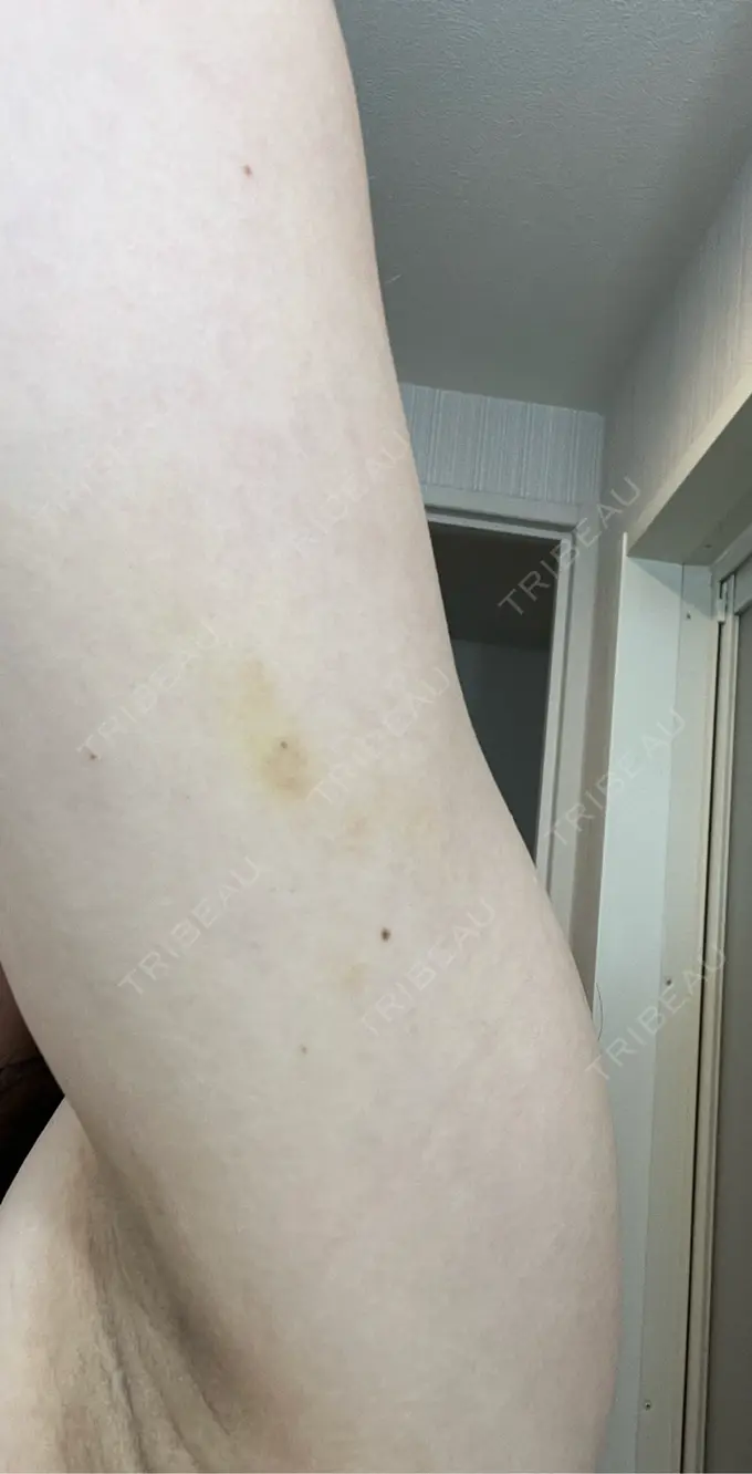 脂肪溶解注射（二の腕） MKクリニック 日本橋院 DAY 8 メイン用