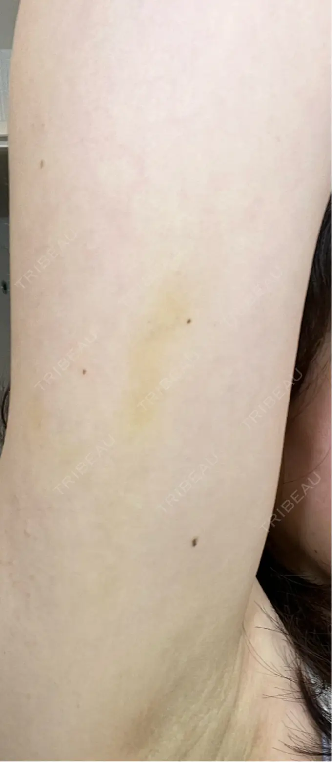 脂肪溶解注射（二の腕） MKクリニック 日本橋院 AFTER メイン用