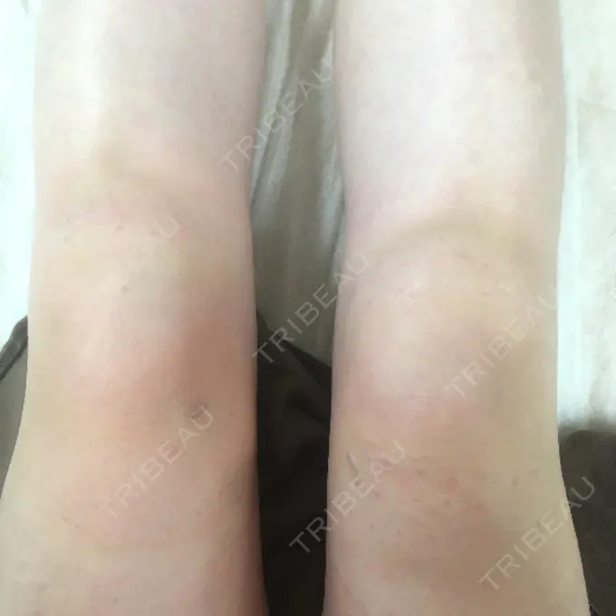 脂肪溶解注射 / その他（ボディ） ヴェリテクリニック 名古屋院 DAY 0 メイン用