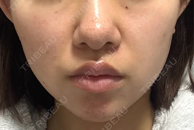 ボトックス（あご） / ボトックス（エラ・小顔） フィラークリニック 大阪梅田院 AFTER メイン用