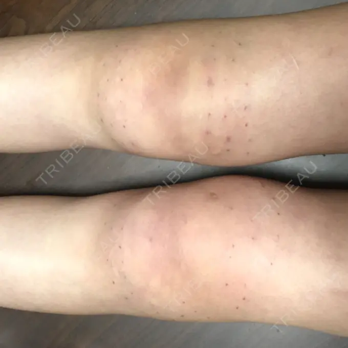 脂肪溶解注射 / その他（ボディ） ヴェリテクリニック 名古屋院 DAY 1 メイン用