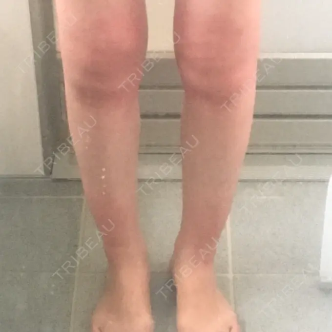 脂肪溶解注射 / その他（ボディ） ヴェリテクリニック 名古屋院 DAY 1 メイン用