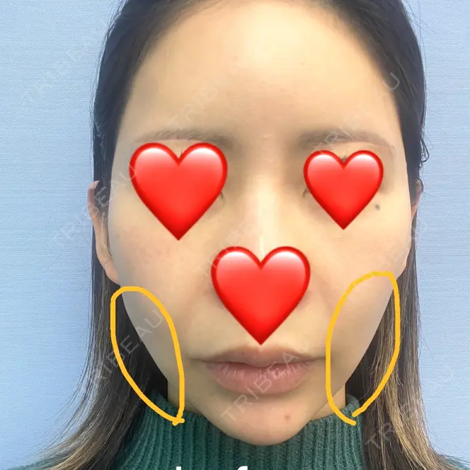 糸リフト 湘南美容クリニック 仙台院 DAY 0 メイン用