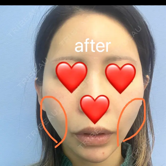 糸リフト 湘南美容クリニック 仙台院 DAY 0 メイン用