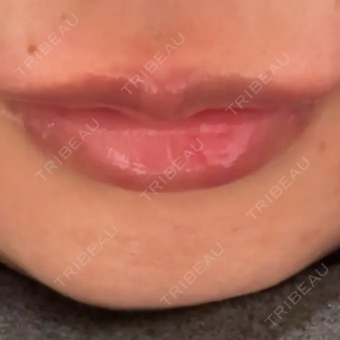 ヒアルロン酸注入（唇） / ボトックス（口角） 銀座美容外科クリニック 銀座院 DAY 0 メイン用