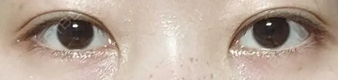 二重埋没 聖心美容クリニック 六本木院 DAY 10 メイン用