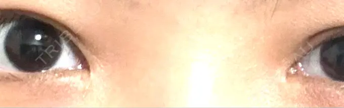 目頭切開 もとび美容外科クリニック 新宿院 AFTER メイン用