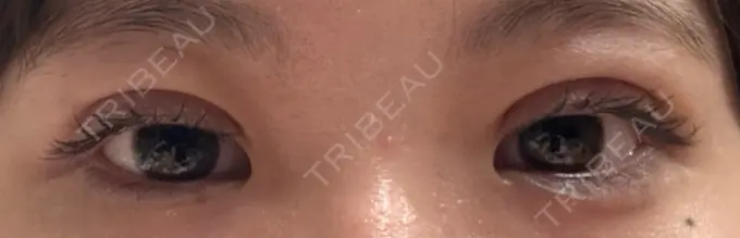 二重埋没 / 自然癒着法 東京シンデレラ美容外科 池袋院 DAY 9 メイン用