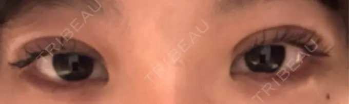 二重埋没 / 自然癒着法 東京シンデレラ美容外科 池袋院 DAY 11 メイン用