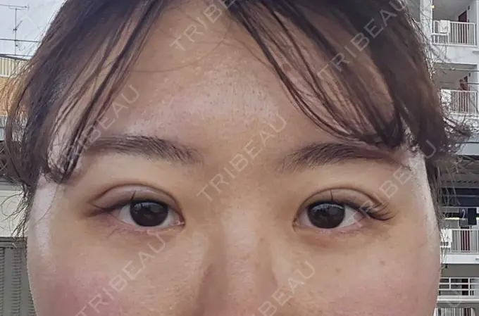 二重埋没 HAAB×DREAM BEAUTY CLINIC 大阪梅田院 DAY 2 メイン用