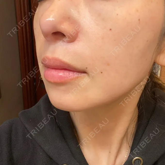 水光注射（ハリ・美肌） 筋肉・美容クリニック AFTER メイン用