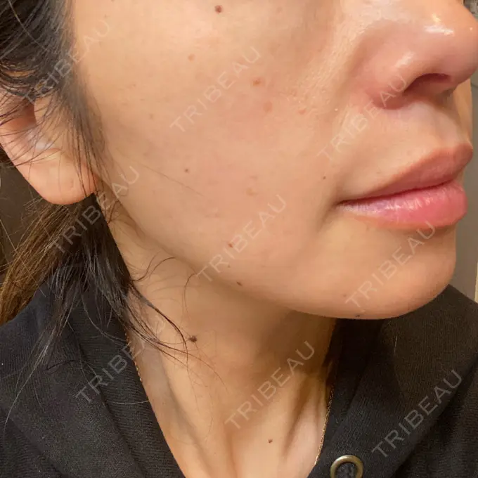 水光注射（ハリ・美肌） 筋肉・美容クリニック DAY 8 メイン用