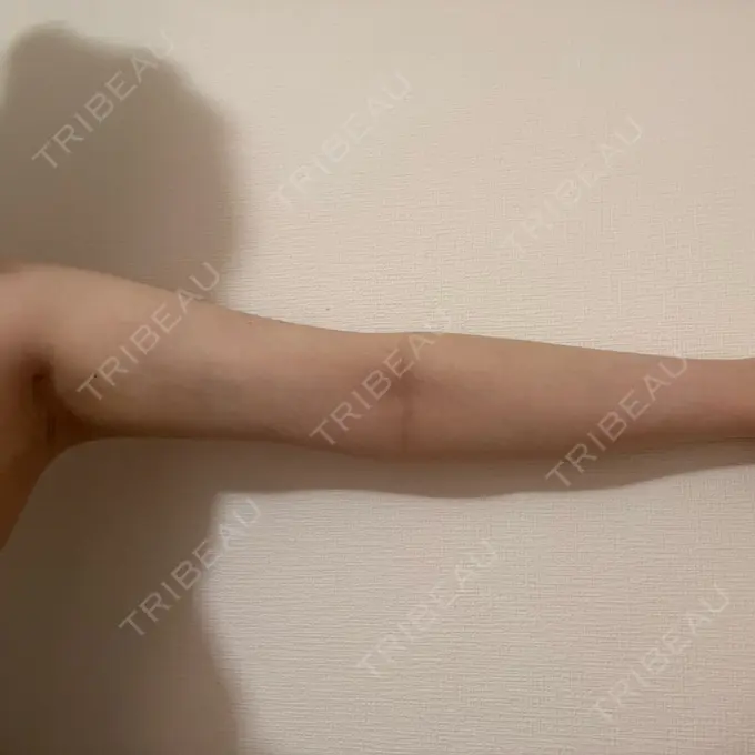 脂肪吸引（二の腕） Mods Clinic（モッズクリニック） 名古屋院 DAY 101 メイン用