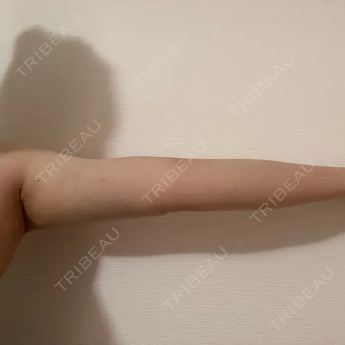 脂肪吸引（二の腕） Mods Clinic（モッズクリニック） 名古屋院 DAY 101 メイン用