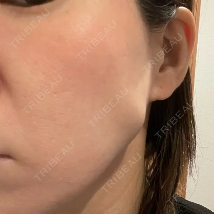 ボトックス（エラ・小顔） / その他（鼻） ルラ美容クリニック 渋谷本院 DAY 1 メイン用