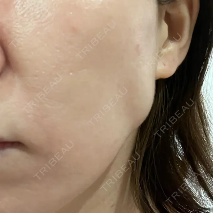 ボトックス（エラ・小顔） / その他（鼻） ルラ美容クリニック 渋谷本院 DAY 7 メイン用