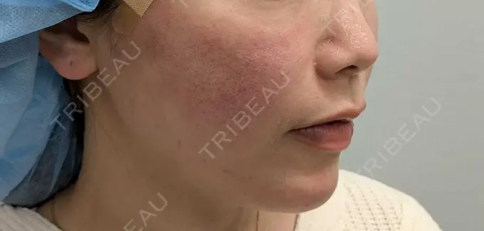 糸リフト 形成外科と美容外科のクリニック池袋 DAY 0 メイン用