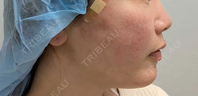 糸リフト 形成外科と美容外科のクリニック池袋 DAY 0 メイン用