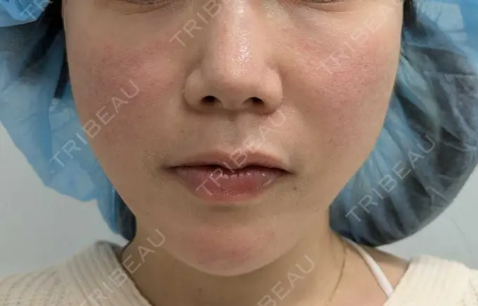 糸リフト 形成外科と美容外科のクリニック池袋 AFTER メイン用