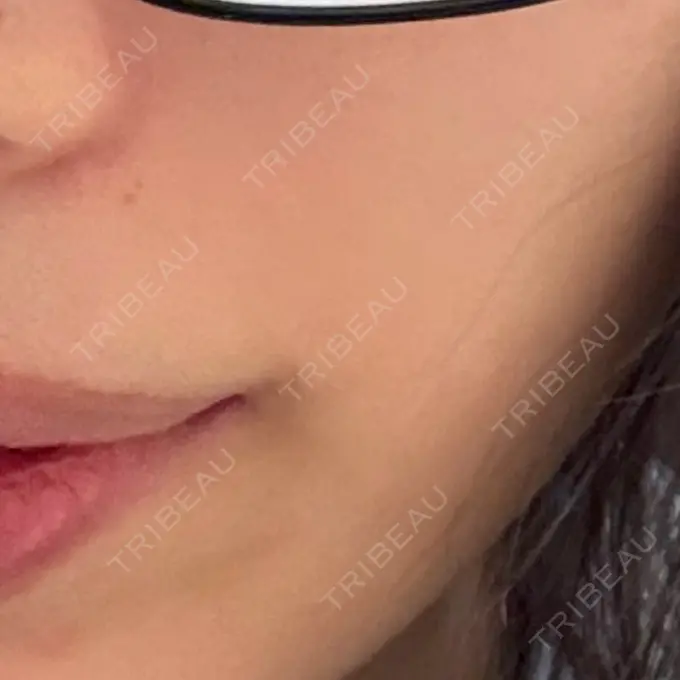 医療脱毛（顔） / 医療脱毛（ワキ） おおかみ美容のクリニック 横浜院 DAY 2 メイン用