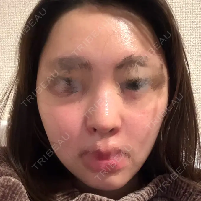 隆鼻術 / 鼻尖形成（切開） / 鼻中隔延長（切開） / 軟骨移植 / 鼻孔縁挙上 / 鼻孔縁下降 / 鼻翼基部形成（貴族手術） / その他（鼻） Designo Clinic （デジーノクリニック） DAY 36 メイン用