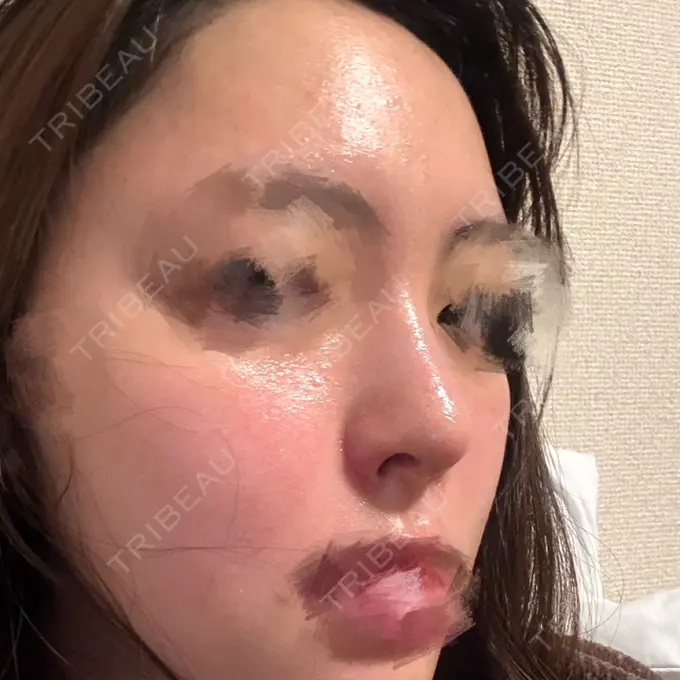 隆鼻術 / 鼻尖形成（切開） / 鼻中隔延長（切開） / 軟骨移植 / 鼻孔縁挙上 / 鼻孔縁下降 / 鼻翼基部形成（貴族手術） / その他（鼻） Designo Clinic （デジーノクリニック） DAY 36 メイン用