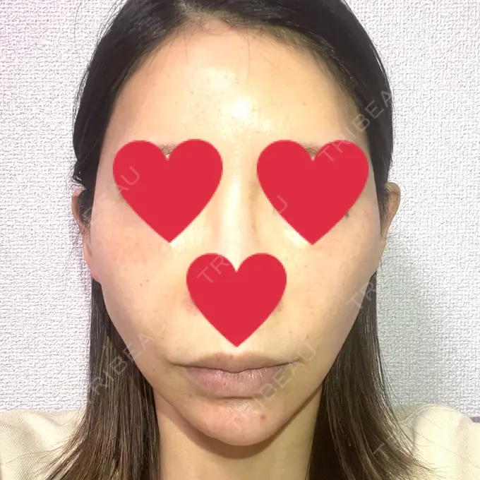 糸リフト 湘南美容クリニック 仙台院 AFTER メイン用