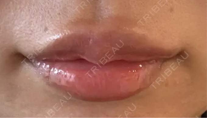 ヒアルロン酸注入（唇） / ボトックス（口角） 銀座美容外科クリニック 銀座院 AFTER メイン用